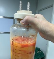 鹤壁水动力吸脂手术要做多久？